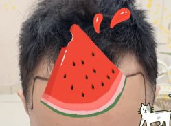 -大麦微针植发全国连锁