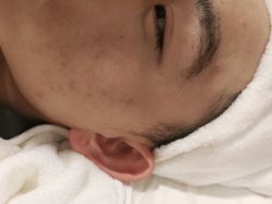 点击看大图 -塑青春&伊肤泉祛痘皮肤管理