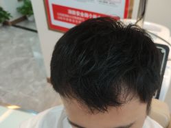-碧莲盛·不剃发植发