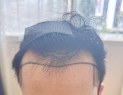 -碧莲盛·不剃发植发