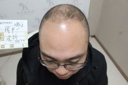 点击看大图 -大麦微针植发丨全国连锁