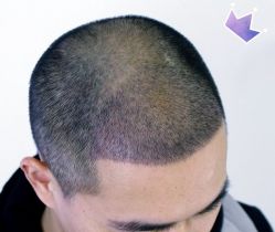 -大麦微针植发丨全国连锁