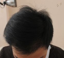 -大麦微针植发全国连锁
