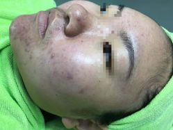 -苗医生草本科技祛痘