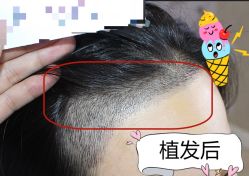 -大麦微针植发全国连锁