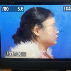 体验后-静港气质医美