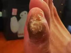 -世龙世家灰指甲鸡眼脚气甲沟炎跖疣护理(通州店)