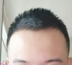 -大麦微针植发丨全国连锁