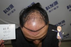 -大麦微针植发丨全国连锁