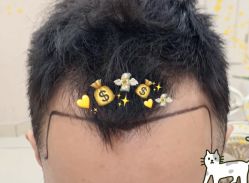 -大麦微针植发全国连锁