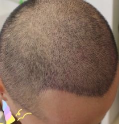 -大麦微针植发丨全国连锁