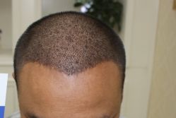 -大麦微针植发全国连锁