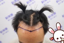 -大麦微针植发丨全国连锁