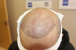 -大麦微针植发丨全国连锁