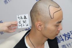 点击看大图 -大麦微针植发丨全国连锁