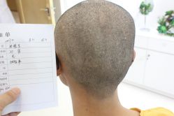 点击看大图 -大麦微针植发丨全国连锁