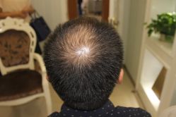 -大麦微针植发丨全国连锁