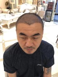 -大麦微针植发丨全国连锁