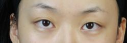 体验前-广州美莱医疗美容医院