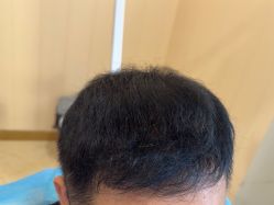 -碧莲盛·不剃发植发