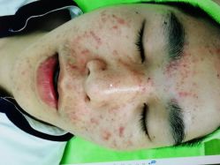 -苗医生草本科技祛痘