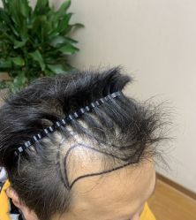 -大麦微针植发全国连锁