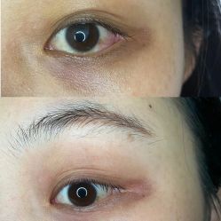 点击看大图 体验前-紫洁俪方(北京)医疗美容