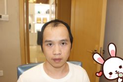 -大麦微针植发丨全国连锁