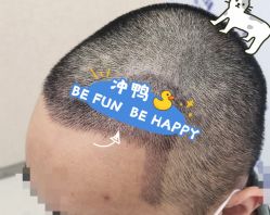 -大麦微针植发全国连锁