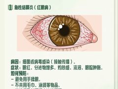 -黑马眼科·近视手术