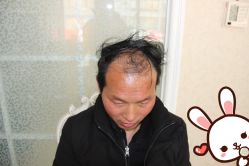 -大麦微针植发丨全国连锁