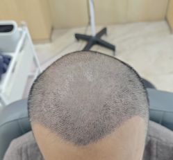 -大麦微针植发丨全国连锁