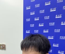 -碧莲盛·不剃发植发