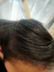 -碧莲盛·不剃发植发