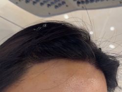 -碧莲盛·不剃发植发