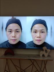 点击看大图 -广州健丽·去眼袋医疗美容机构