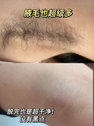 -薇兰专业脱毛连锁机构