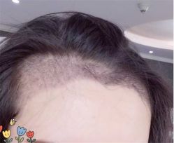 点击看大图 -大麦微针植发全国连锁