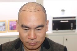 点击看大图 -大麦微针植发丨全国连锁