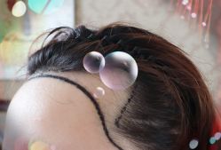 -大麦微针植发全国连锁