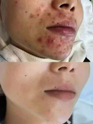 -瑶芳清颜草本祛痘