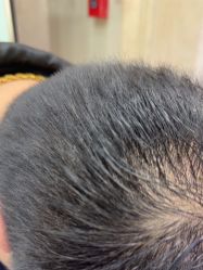 -碧莲盛·不剃发植发