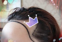 -大麦微针植发全国连锁