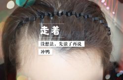 -大麦微针植发全国连锁