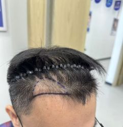 -大麦微针植发全国连锁