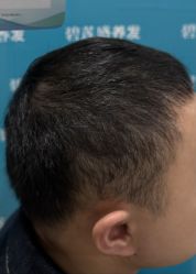 -碧莲盛·不剃发植发