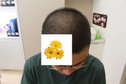 -大麦微针植发丨全国连锁