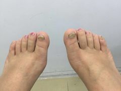 -世龙世家灰指甲·甲沟炎·跖疣护理·修脚(东江湾路店)