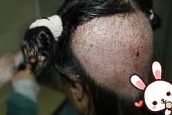 -大麦微针植发丨全国连锁