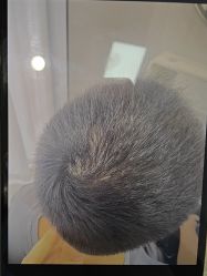 -大麦微针植发丨全国连锁